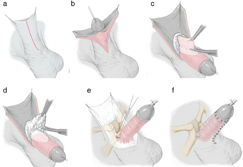 Ligamentotomy for penis enlargement