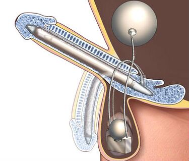 Penile prosthesis for penis enlargement