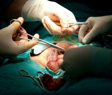Penis enlargement surgery